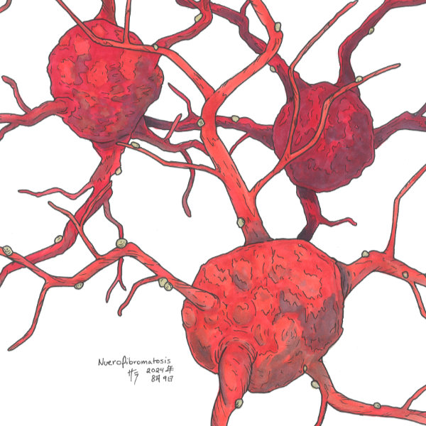 cancer neurofibromatosis